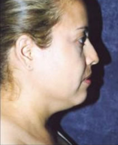 Facial Liposuction Before & After Image