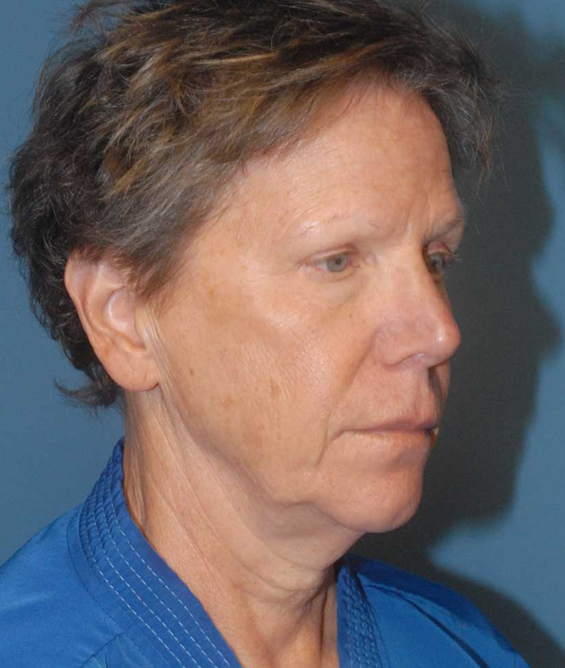 Neck Lift Before & After Image
