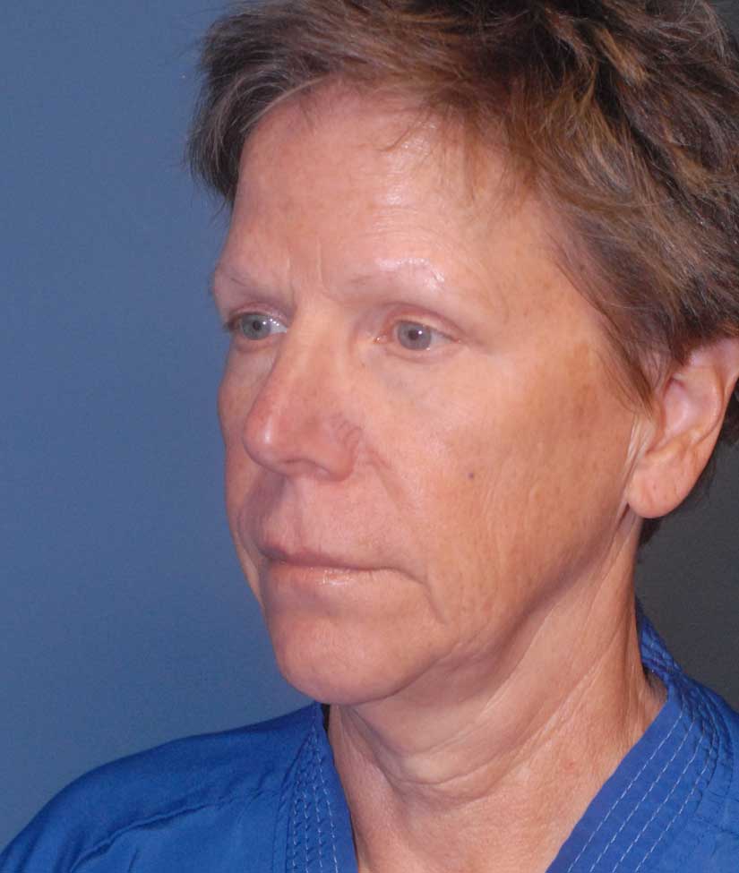 Neck Lift Before & After Image
