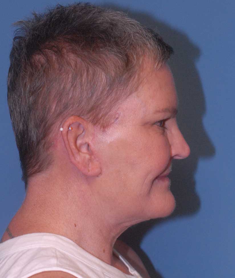 Neck Lift Before & After Image