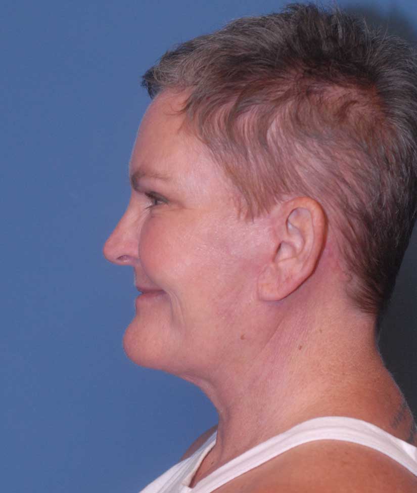 Neck Lift Before & After Image