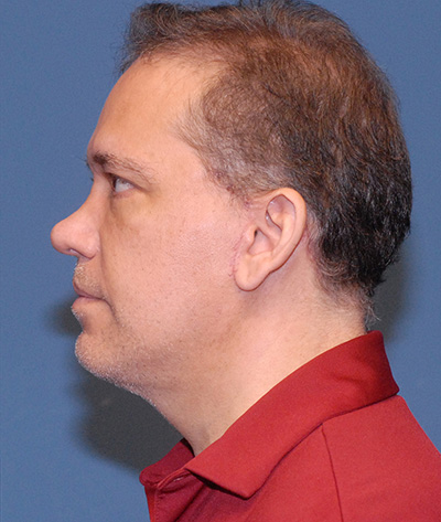 Neck Lift Before & After Image
