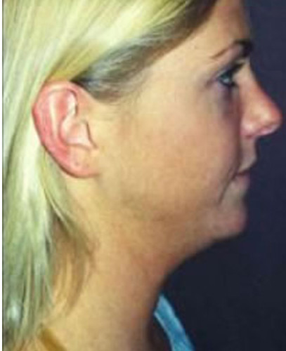 Rhinoplasty Before & After Image