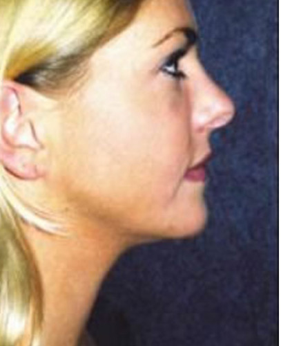 Rhinoplasty Before & After Image