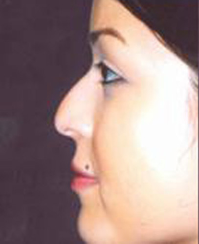 Rhinoplasty Before & After Image