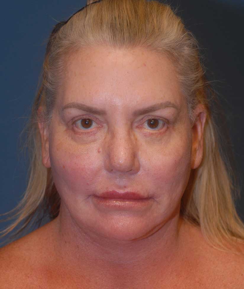 Rhinoplasty Before & After Image