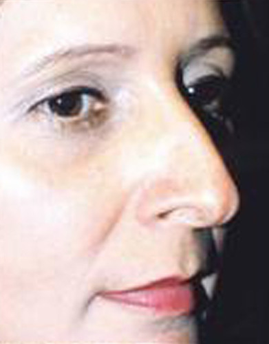 Rhinoplasty Before & After Image