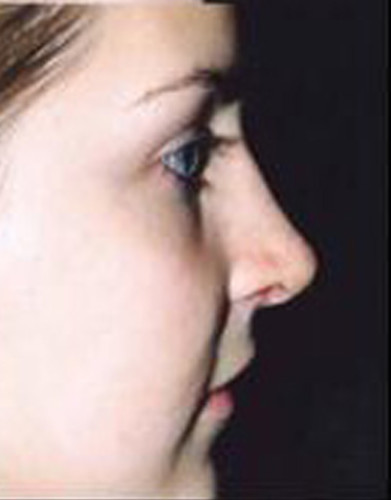 Rhinoplasty Before & After Image
