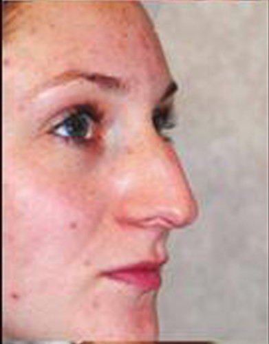 Rhinoplasty Before & After Image