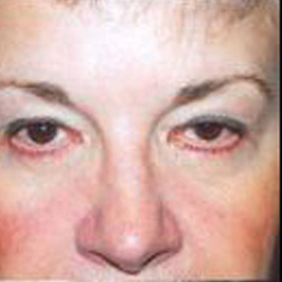 Rhinoplasty Before & After Image