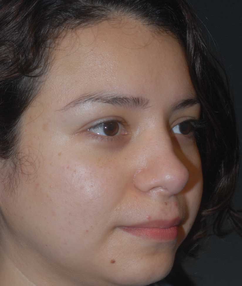 Rhinoplasty Before & After Image
