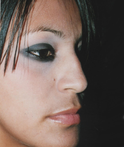 Rhinoplasty Before & After Image