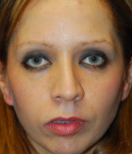 Rhinoplasty Before & After Image
