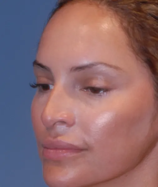 Rhinoplasty Before & After Image