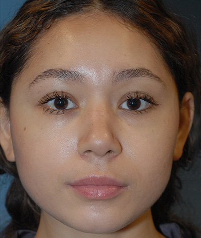 Rhinoplasty Before & After Image