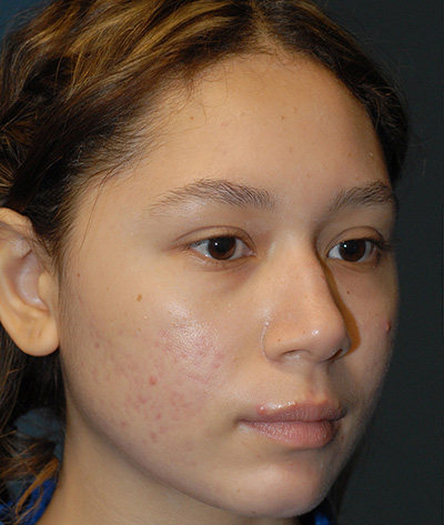 Rhinoplasty Before & After Image