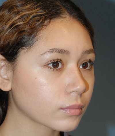 Rhinoplasty Before & After Image