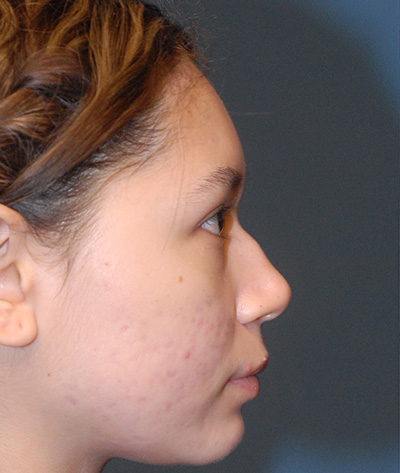 Rhinoplasty Before & After Image
