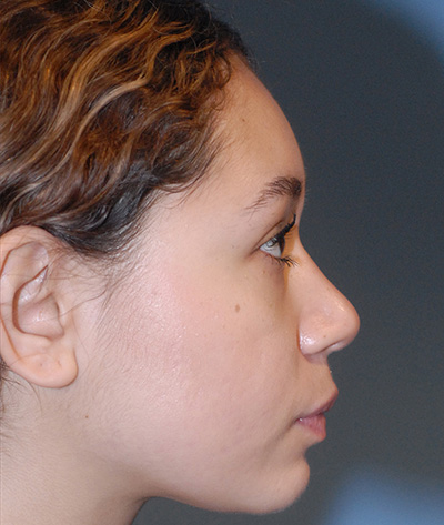 Rhinoplasty Before & After Image