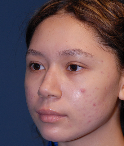 Rhinoplasty Before & After Image