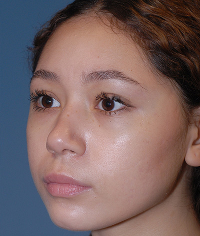 Rhinoplasty Before & After Image