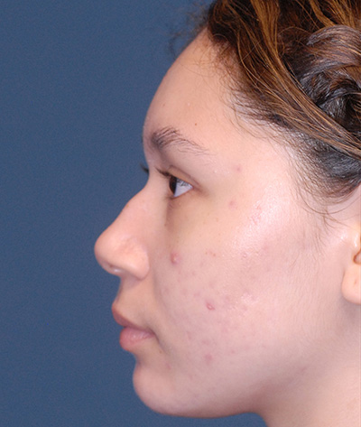 Rhinoplasty Before & After Image