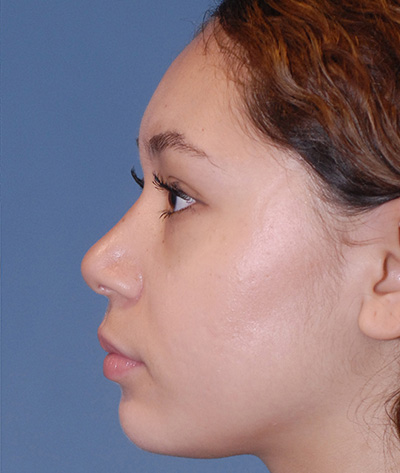 Rhinoplasty Before & After Image