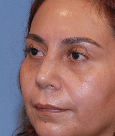 Rhinoplasty Before & After Image