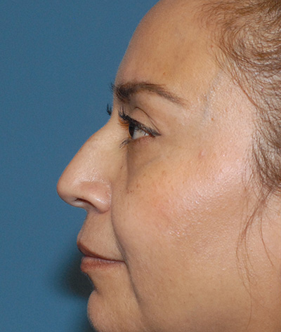 Rhinoplasty Before & After Image