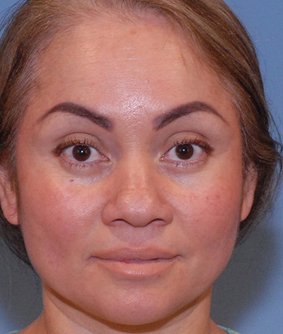 Rhinoplasty Before & After Image