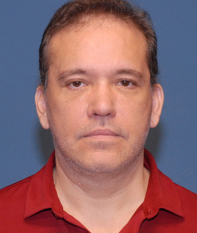 Male Blepharoplasty Before & After Image