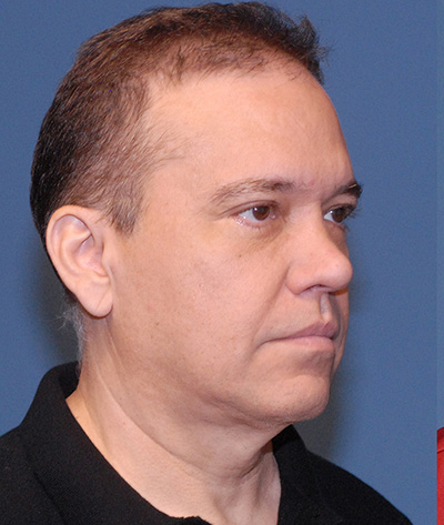 Male Blepharoplasty Before & After Image