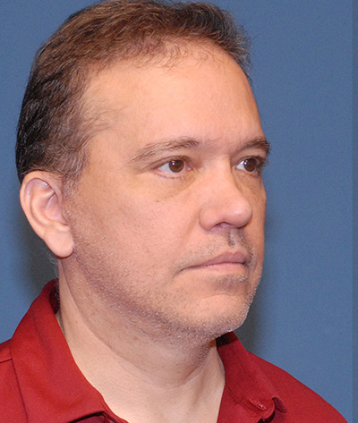 Male Blepharoplasty Before & After Image