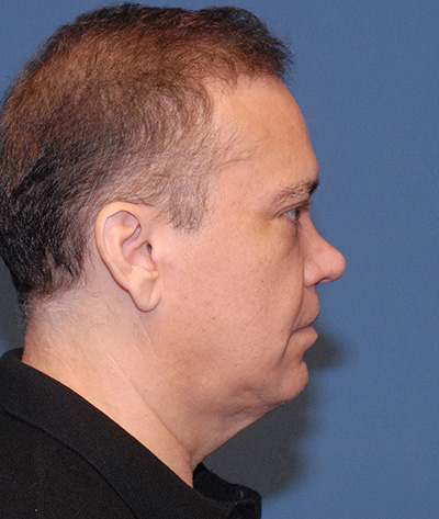 Male Blepharoplasty Before & After Image