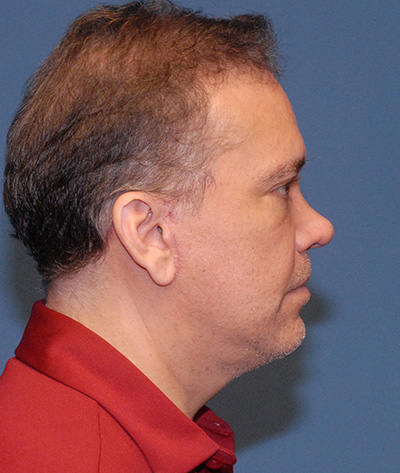 Male Blepharoplasty Before & After Image