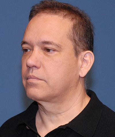 Male Blepharoplasty Before & After Image