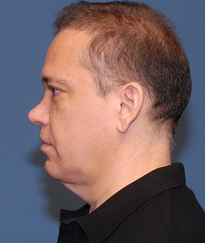 Male Blepharoplasty Before & After Image