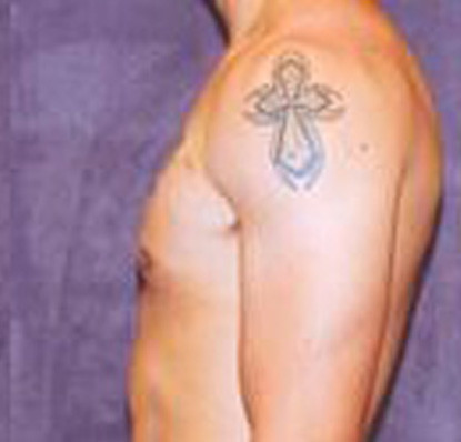 Gynecomastia  Before & After Image