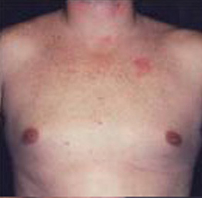 Gynecomastia  Before & After Image