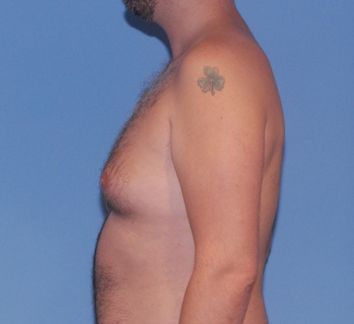 Gynecomastia  Before & After Image