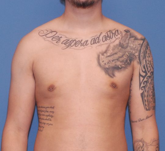 Gynecomastia  Before & After Image