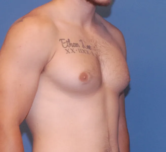 Gynecomastia  Before & After Image
