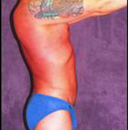 Male Body Contouring  Before & After Image