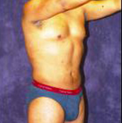 Male Body Contouring  Before & After Image