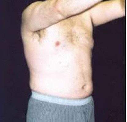 Male Body Contouring  Before & After Image