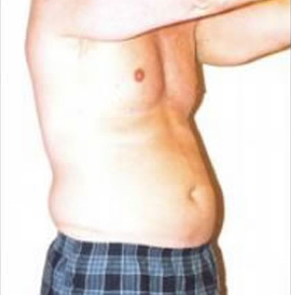 Male Body Contouring  Before & After Image