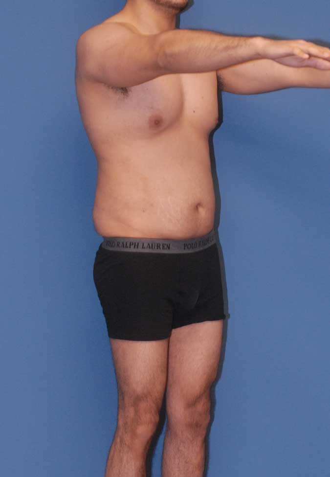 Male Body Contouring  Before & After Image