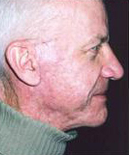 Male Facial Rejuvenation  Before & After Image