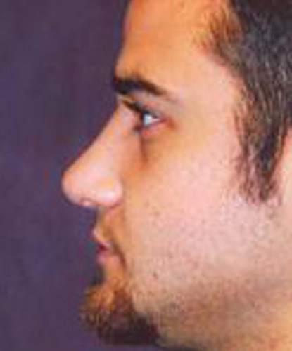 Male Facial Rejuvenation  Before & After Image