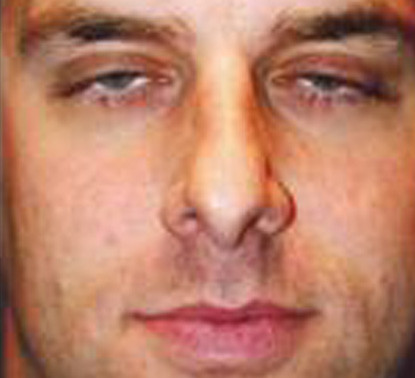 Male Facial Rejuvenation  Before & After Image